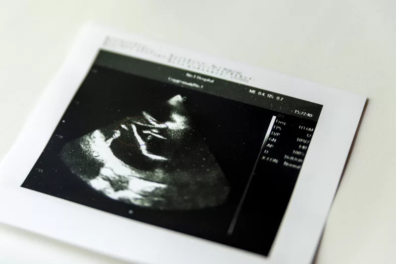 Ультразвуковое исследование сердца плода: детальный снимок