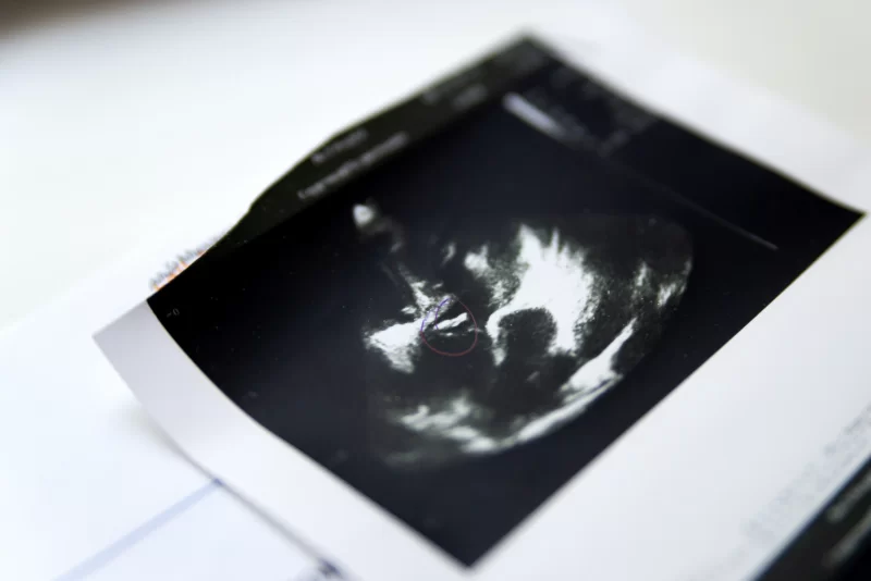 УЗИ будущего ребенка: первый взгляд на малыша